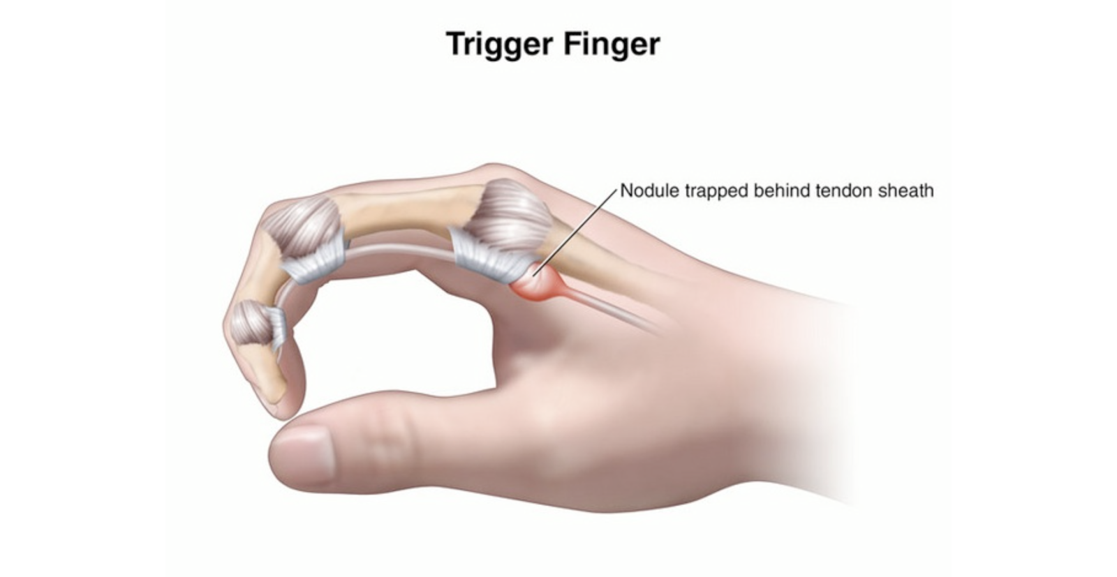 Стенозирующий лигаментит кольцевидных связок пальцев. Болезнь нотта. Стенозирующий лигаментит нотта. Сухожилия 1-го пальца кисти. Лигаментит сухожилий.