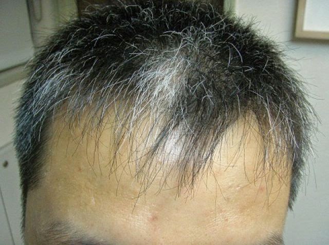 少年白頭 竟是白斑症作怪