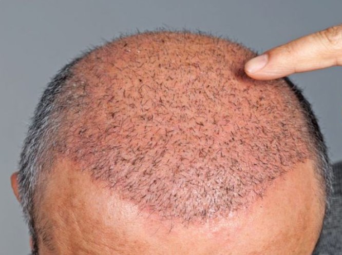Hair Transplant Eliminates Hair Loss, Learn The Complete Process And Costs