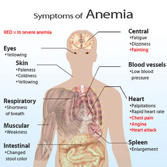anemia pica symptoms anemia pica symptoms