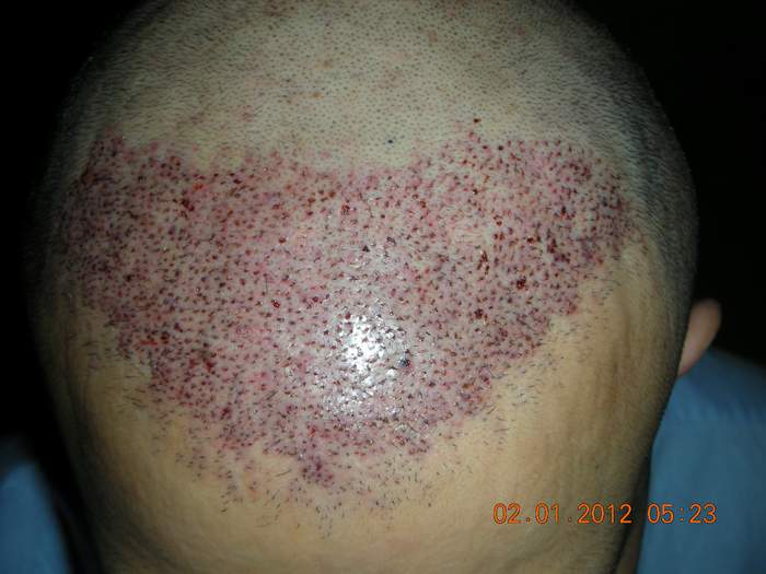 Hair Transplant,Hair Restoration,FUE in Ireland