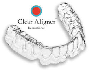 Niềng răng không mắc cài Clear Aligner giá bao nhiêu ?