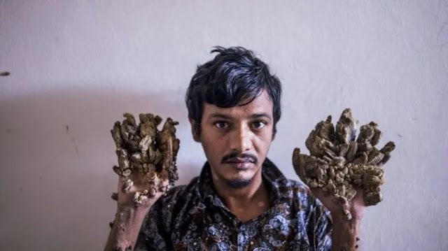 El 'hombre árbol' bangladesí pide ser amputado