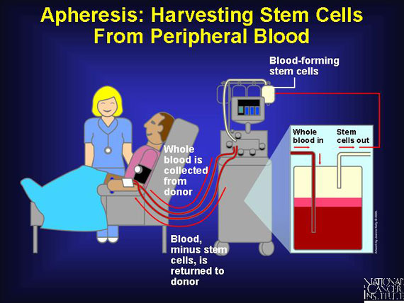 A Marrow Chronicle: Donor's Perspective part 2; Apheresis