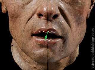 дефлексия во время открытия рта нижняя челюсть отклоняется, и межрезцовая линия уходит с середины.