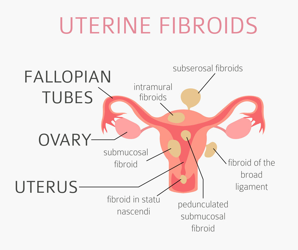 All you need to know about uterine fibroids-Causes, Symptoms and Treatment