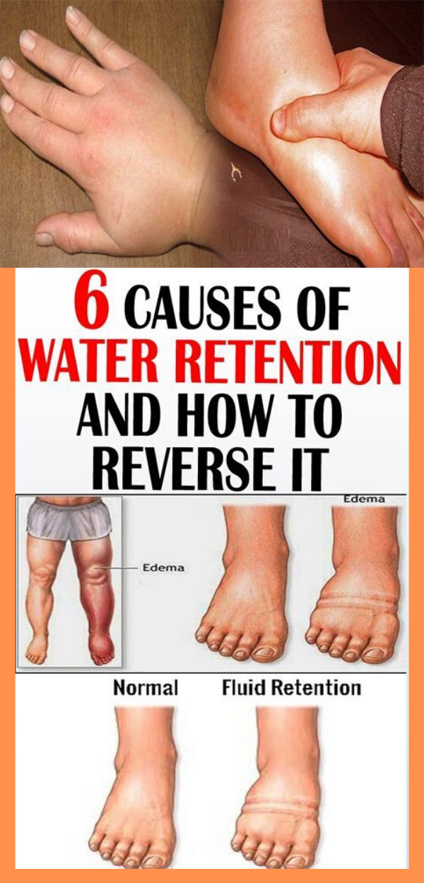 Stunning Tips About How To Prevent Fluid Retention During Pregnancy