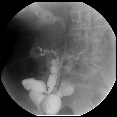 Topics in Radiography: Loopogram