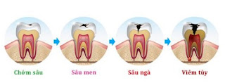 Răng cấm bị sâu có nên nhổ-2