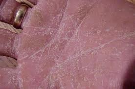 Peeling skin on the palm - Dermatology - MedHelp