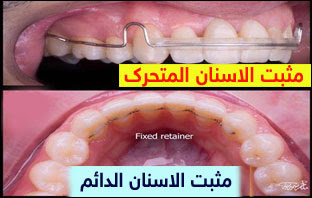 سعر مثبت الأسنان بعد تقويم الأسنان أقل بـ 40 دولارًا