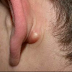 How to Get Rid of a Cyst Fast, Naturally at Home, Without Surgery