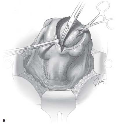 Removal of fibroid from myometrium