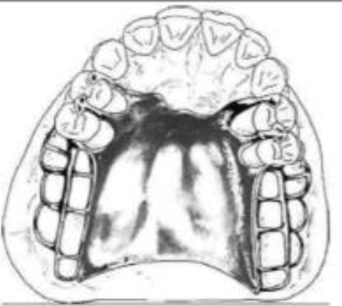 Major connector of RPD l Removable partial denture MCQs WikiDentia