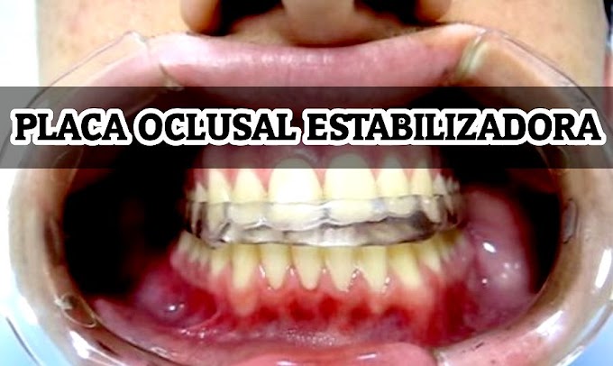 OCLUSÃO: Placa Oclusal Estabilizadora