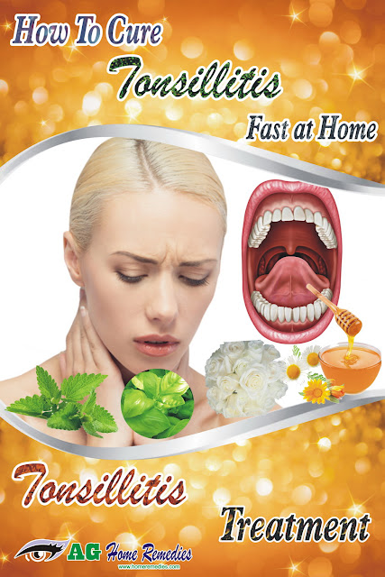 How To Cure Tonsillitis Fast At Home Tonsillitis Treatment Natural