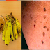 Get Rid Of Your Moles, Warts, Blackheads, Skin Tags and Age Spots Using Natural Ingredients