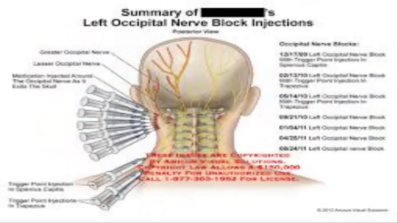 Occipital neuralgia