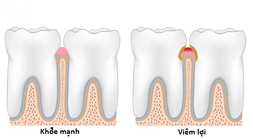 Chăm sóc sức khoẻ: Các loại viêm lợi ở trẻ em Cac_loai_viem_loi_o_tre