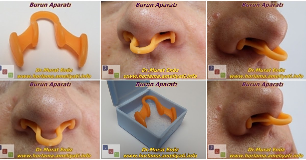 Can AntiSnoring Nose Devices Stop Snoring Alone?