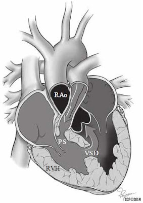 Tetralogy of Fallot