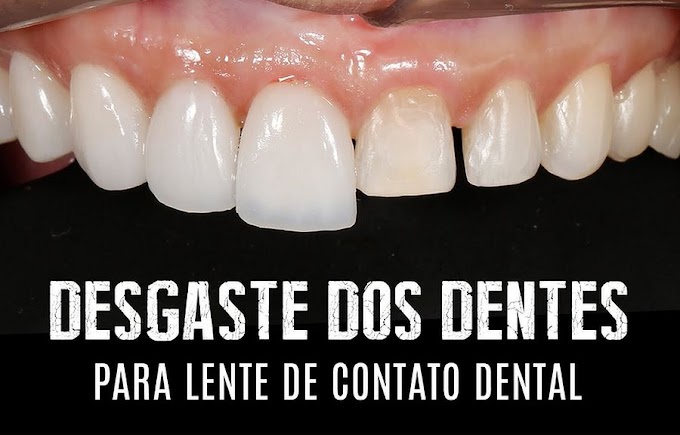 FACETAS DENTÁRIAS: Desgaste dos dentes para lentes de contato dentais e facetas em porcelana - Dr. Adriano Abreu