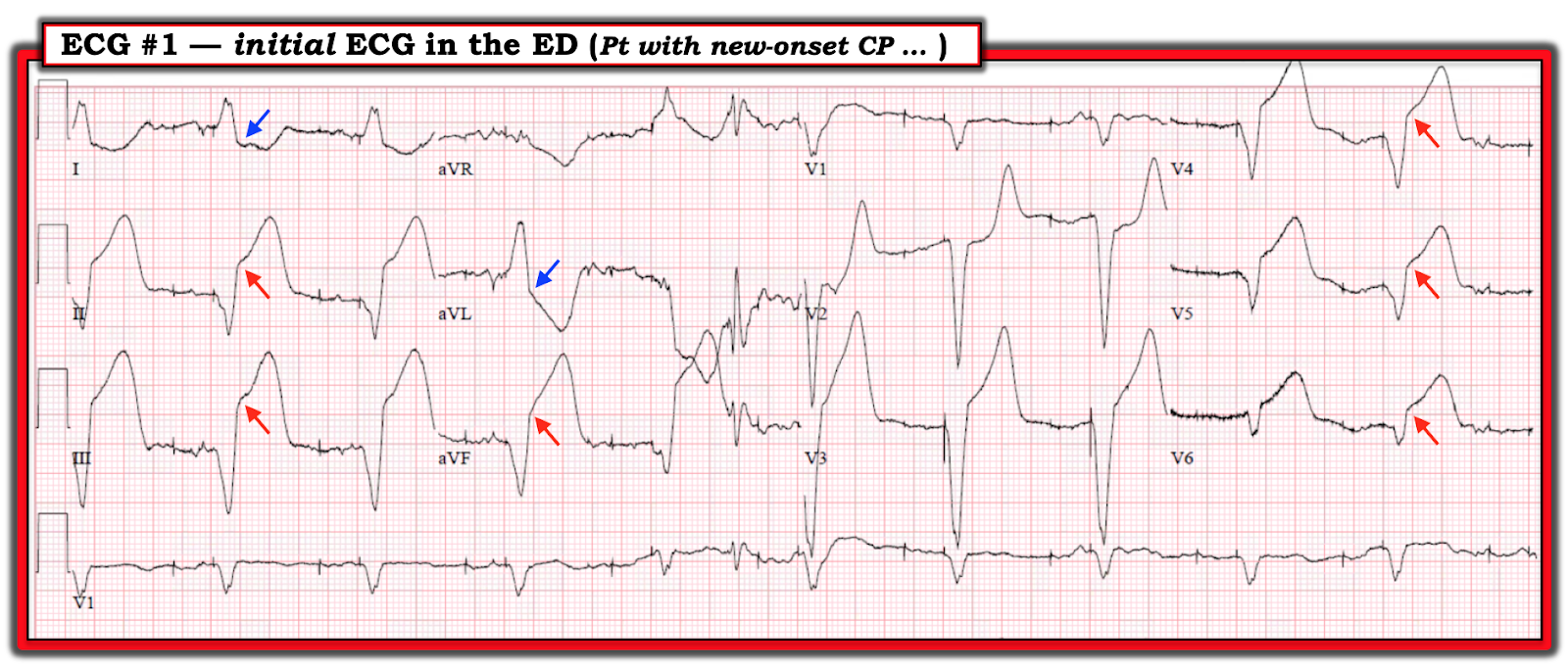 экг расшифровка шпаргалка. экг норма и патология расшифровка. как прочитатькардиограму. экг. чтение экг.