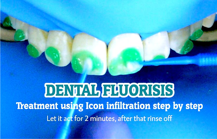 DENTAL FLUOROSIS Treatment using Icon Infiltration Step by Step