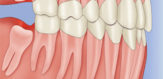 Răng khôn nên giữ lại trong những trường hợp nào? Hhff