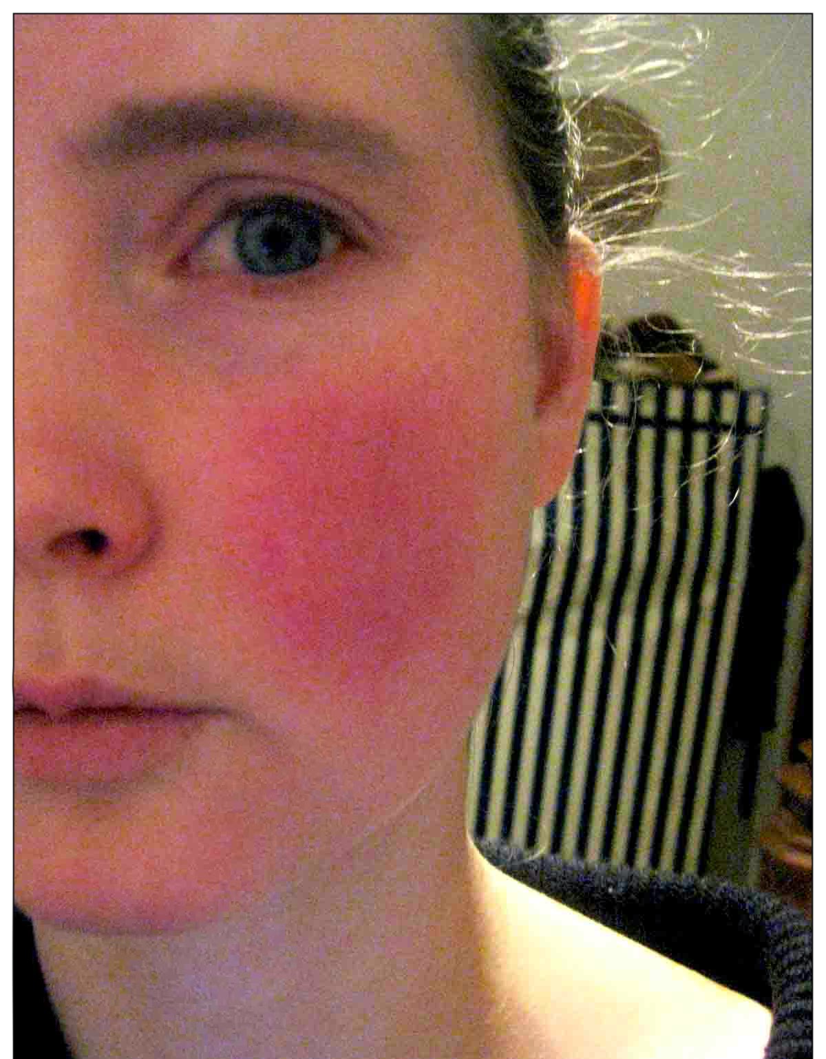 Scarlet Letters, dealing with vascular rosacea, face flushing, burning