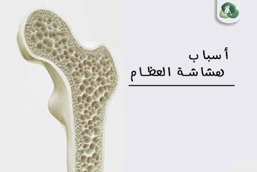 هشاشة العظام Osteoporosis الأعراض والأسباب و العلاج بالاعشاب