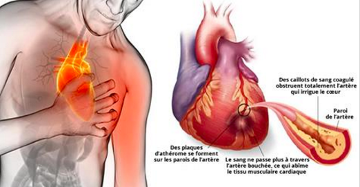 80% des crises cardiaques pourraient être évitées si tout le monde faisait ceci