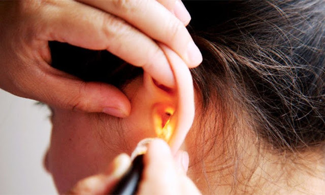 Cerumen en el Oído Una adecuada limpieza del oído