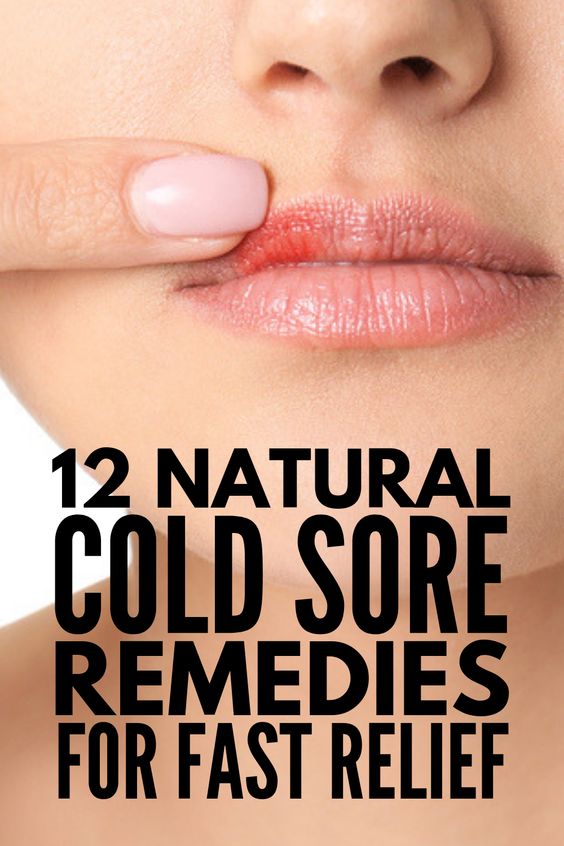 Fast And Effective 12 Natural Cold Sore Remedies That Work Wellness