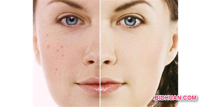 serum terbaik yang bagus untuk muka jerawat