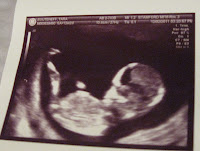 sequential screening while pregnant sequential screening while pregnant