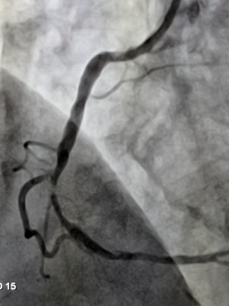 малый стеноз. стентирование позвоночной артерии. атеросклероз бляшка сонной артерии. декомпенсированный стеноз привратника рентген. малый стеноз.