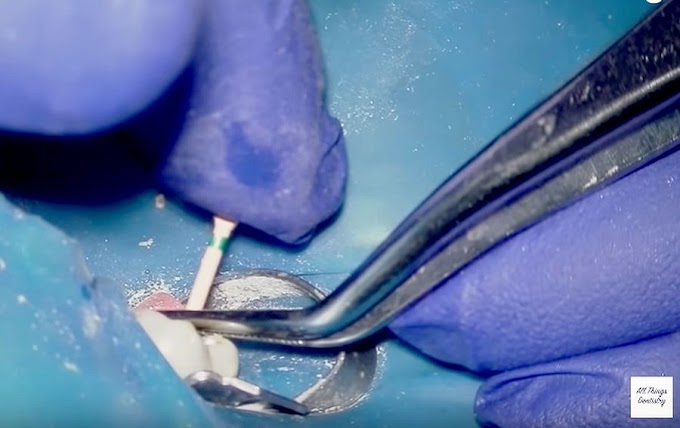 ENDODONTICS: Root Canal Treatment in 1 hour 