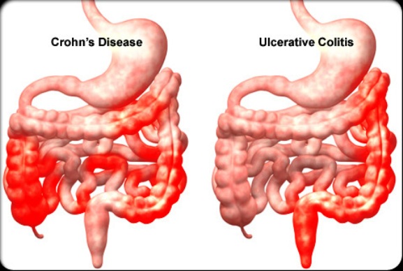Differences Between Crohn's Disease and Ulcerative Colitis