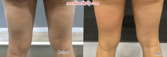 Cellulite Buster, Exilis Ultra 360, Slimming Review, Beauty, Exilis Ultra 360 Review, Cellulite, 