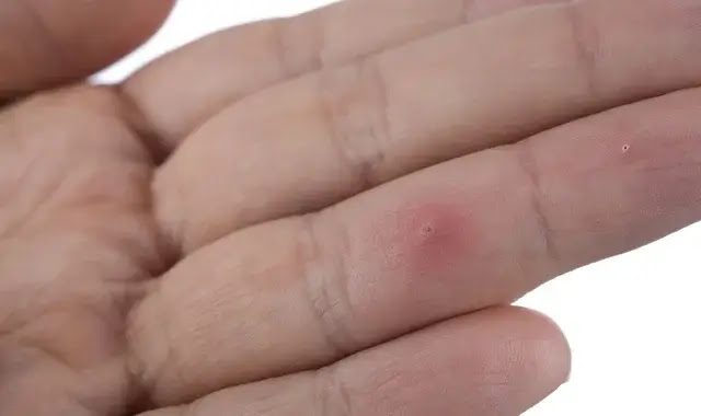 How to remove the splinter that enters the skin