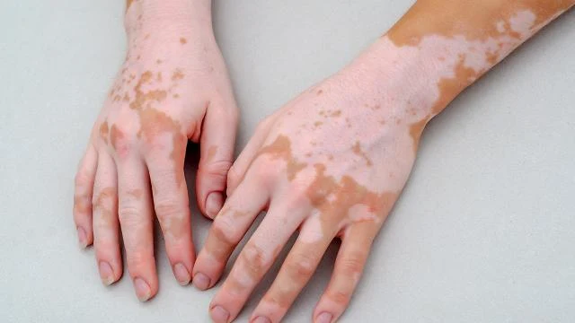 Vitiligo, una enfermedad que se hereda