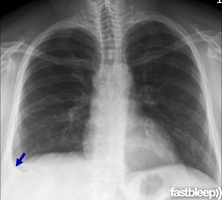 EpoportMengiau A lil' bit of CXR