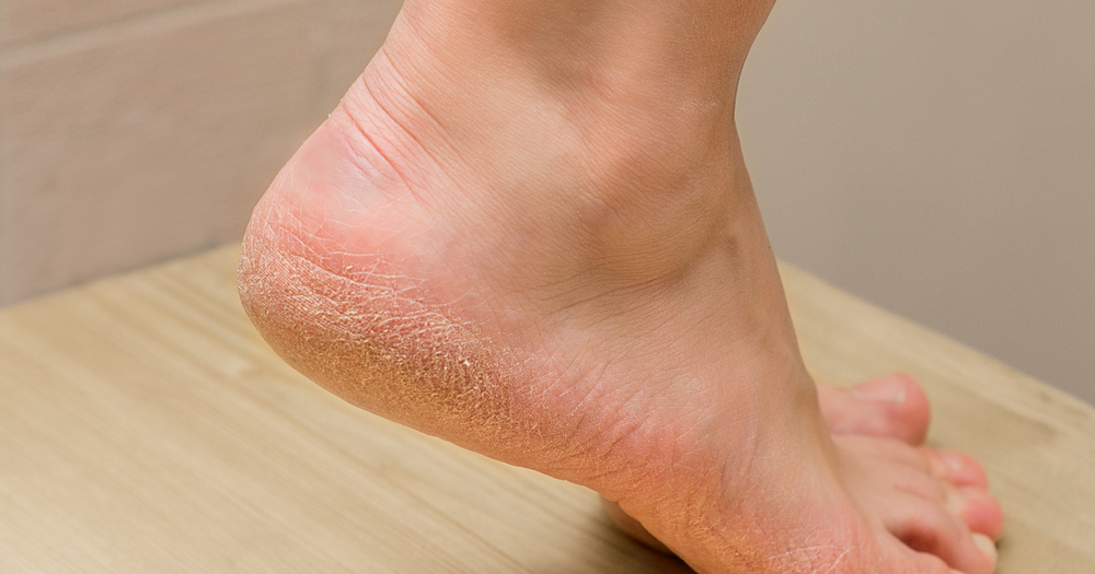 Cracked Heels Makes No Confidence, This is The Solution