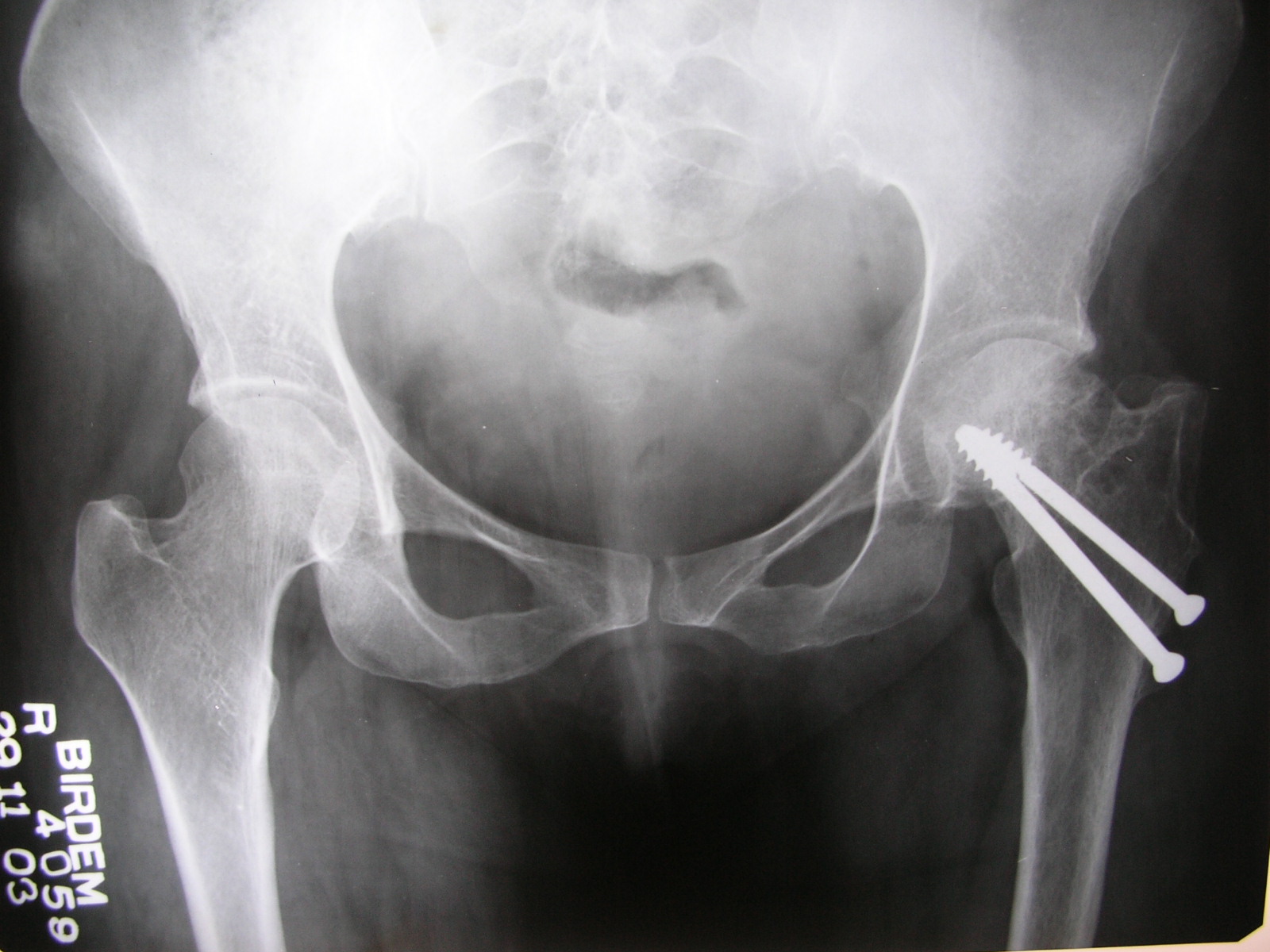 Xrays and Slides AVN of left femoral head from old