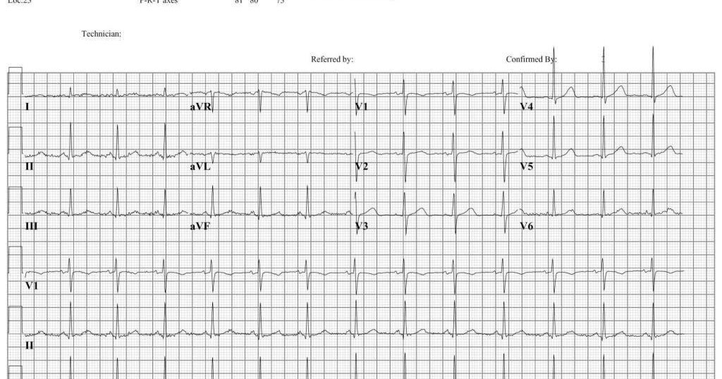 Nodus Sinus Rhythm dan Aritmiasi
