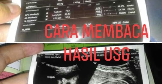 Cara Membaca Hasil USG Rahim - Literasi Perawat