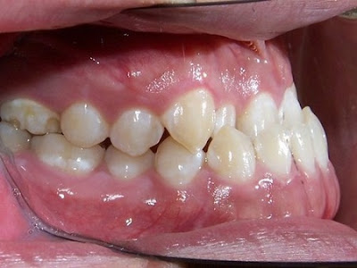Quá trình niềng răng móm