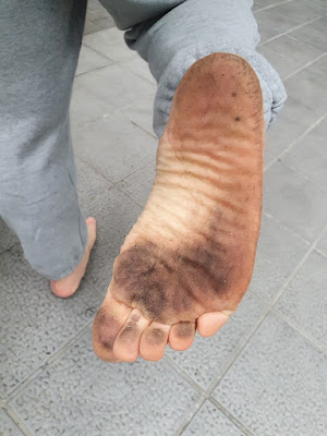 赤腳走路 預防足底筋膜炎