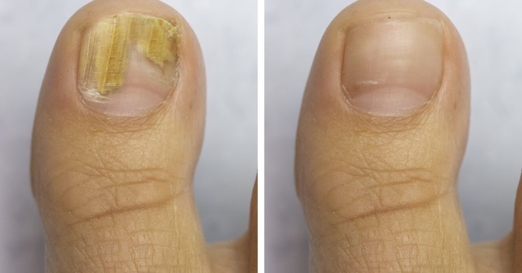 Getting Rid of Toenail Fungus